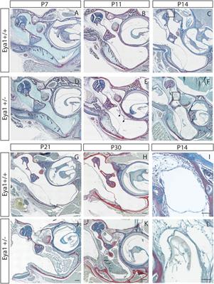 The interconnected relationships between middle ear bulla size, cavitation defects, and chronic otitis media revealed in a syndromic mouse model